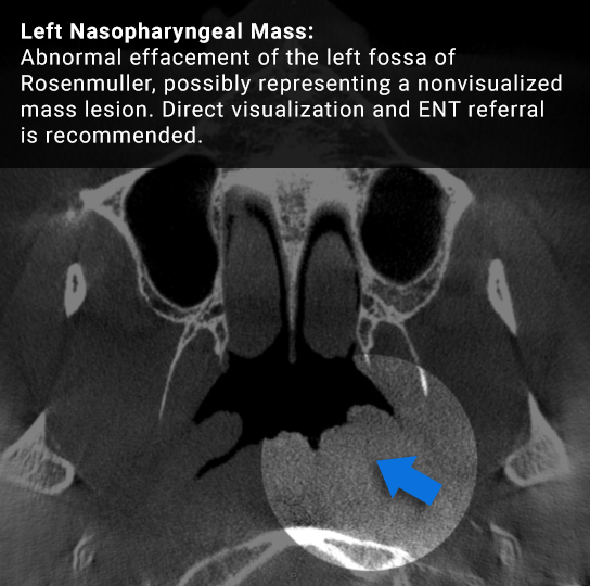 Image of an actual study taken from a CBCT machine with the associated finding labeled on it