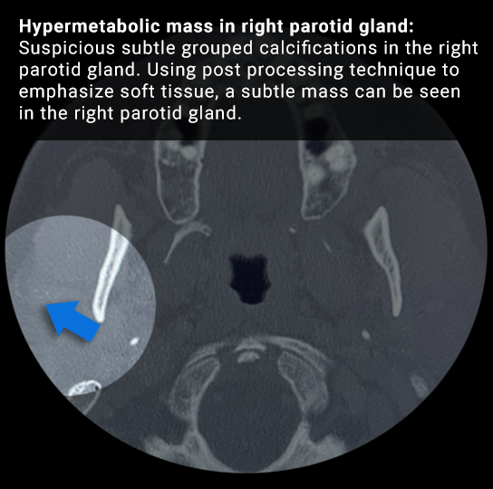 Image of an actual study taken from a CBCT machine with the associated finding labeled on it